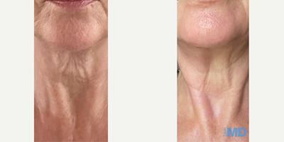 55-64 year old woman treated with NeoGen Plasma - This lovely patient received 1 high energy NeoGen treatment. Notice the dramatic improvement to her skin texture, tone and tightness! The patient is especially thrilled with the minimized wrinkles/fine lines around her mouth and the tightening on her neck.