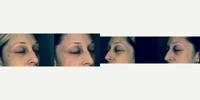 25-34 year old woman treated for blue veins at the temples with the Nd-Yag Laser - I used this filter to show the improvement of veins around the eyes. Focus your attention to the temples. Those blue veins are no longer present in the after photo.