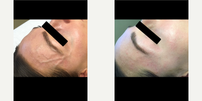 25-34 year old woman treated with Asclera for Face Sclerotherapy - Before & After only 2 sessions of face sclerotherapy.