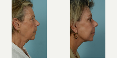 65-74 year old woman treated with Facelift, SMAS Facelift, Neck Lift, Eyelid Surgery, Brow Lift, Facial Fat Transfer, Laser Resu - At the vibrant age of 71, this patient elected to undergo several procedures with Dr. Thomas Mustoe to preserve her natural beauty and active lifestyle without an overly tight or pulled appearance. Her personalized facial rejuvenation included a deep plane facelift/minilift, neck lift, upper blepharoplasty, brow lift, and fat grafting around the mouth, all performed by the skilled hands of Dr. Mustoe in Chicago. Post-procedure results, observable just one month post-op, reflect her desire for a subtle but impactful alteration, enhancing her already attractive features while maintaining her characteristic expressions.The above patient sought to leverage Dr. Mustoe's proficiency not only in facelift/minilift techniques but also in neck lift, blepharoplasty, brow lift, and fat grafting procedures. In addition to these, laser treatment and dermabrasion were used to augment the smoothness and youthfulness of her skin near the mouth area. The successful outcome demonstrates Dr. Mustoe's commitment to meeting the patient's unique requirements. Despite her age, the patient continues to lead a vibrant life post-procedure, which highlights minimal impact on her active lifestyle due to Dr. Mustoe's careful and thoughtful approach.Known for his personalized approach and optimal results, Dr. Thomas Mustoe is an American board-certified plastic surgeon and a respected authority in the field. Renowned for conducting over 10,000 operations, Dr. Mustoe's practice, TLKM Plastic Surgery, located at 737 North Michigan Ave., Chicago, offers innovative and age-defying techniques, including the facelift/minilift procedure. The patient's experience showcases Dr. Mustoe's ability to balance surgical control and aesthetic sensitivity to deliver naturally beautiful results that satisfy the patient's desires while preserving their unique identity.