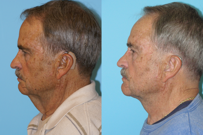 Necklift - 	This patient wanted to get rid of the waddle under his neck. he was not interested in performing a lower face and neck lift, and opted for doing a neck lift only, which focused solely on the neck skin and not the jowls or jawline.