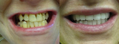 Multiple Porcelain Veneers  - Patient received more than 20 crowns in just one appointment. &nbsp;Dr. Sarah Thompson was careful not to make her teeth too white or too perfect because she did not want them to look fake. The slight imperfections were made on purpose. The goal is always to appear naturally beautiful.