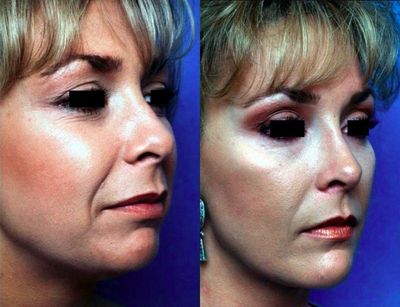 Cheek implant, chin implant & rhinoplasty - Before and after cheek implant, chin implant & rhinoplasty