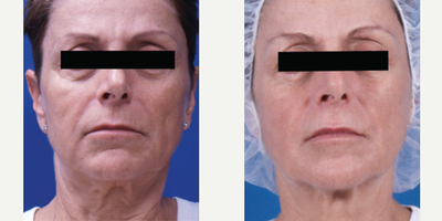 55-64 year old woman treated with Venus Legacy - Treated with Venus Legacy.