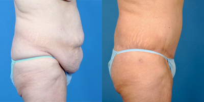45-54 year old woman treated with Body Lift - Patient lost 60 pounds, diet and exercise. Treated with a Lower Body Lift (Circumferential Abdominoplasty) 9 months ago.