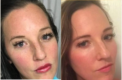 35-44 year old woman treated with Pico Genesis - Treated with PICO laser