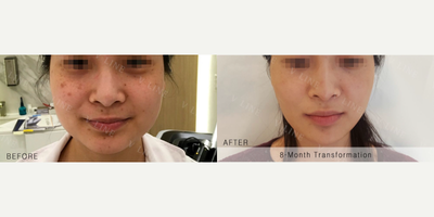 35-44 year old woman treated with PicoSure - 35-44 year old woman treated with PicoSure, 8 Sessions/ 1 Each month.