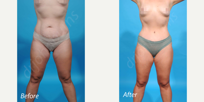 35-44 year old woman treated with liposuction - Bikini incision abdominoplasty/tummy tuck with rectus diastasis repair and liposuction