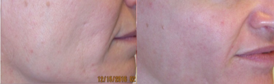 35-44 year old man treated with  Pearl Laser Resurfacing - Patient treated with the Pearl Fractional to increase volume and reduce lines in just one treatment. Pearl Fractional offers the best combination of patient experience and recovery time. Patients will see improvements in photodamage, tone and texture as well as a noticeably smoother, brighter complexion.