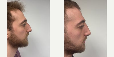 25-34 year old man treated with Rhinoplasty - 3 weeks after a rhinoplasty