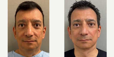 55-64 year old man treated with Deep Plane Facelift - 60 y/o male s/p Deep Plane Neck and Facelift performed in our on site AAAA certified operating suite.