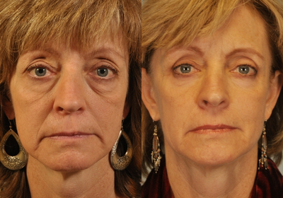Phenol Peel - 
	This patient underwent a lower lid Hetter Peel and an upper and lower blepharoplasty.
