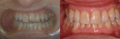 Bonding - 
	Patient did cosmetic bonding
