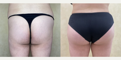 Woman treated with Hip Augmentation - Woman treated with Hip Augmentation using implants