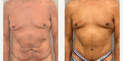 66 year old man treated with Male Tummy Tuck - 66 year old man treated with Male Tummy Tuck
