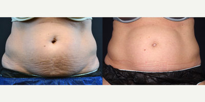 55-64 year old woman treated with CoolSculpting - 57 year old female received 2 CoolCore applicators to her lower abdomen, 1 CoolCore applicator on each anterior flank, and 1 CoolCore applicator on each posterior flank.