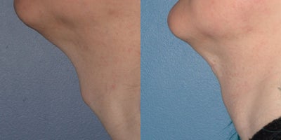 35-44 year old woman treated with Adam's Apple Reduction - A Transwoman who desired reduction on tracheal prominence aka Adam's apple. Chondrolaryngoplasty or Tracheal Shave was performed. The incision is well hidden in the junction between the submental area and neck.