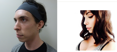 25-34 year old woman treated with Facial Feminization Surgery - Woman treated with Facial Feminization Surgery