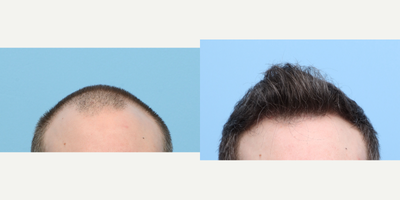35-44 year old man treated with FUE Hair Transplant, Hair Transplant, Hair Loss Treatment, PRP for Hair Loss, PRP Injections - Dr. Wise conducted an FUE hair transplant procedure along with a session of PRP therapy. The patient aimed to address hairline recession and enhance overall hair density. A total of 3,020 grafts were implanted in the frontal region of the scalp to accomplish these results.
