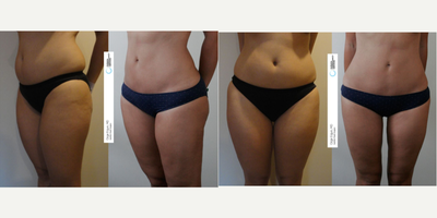 25-34 year old woman treated with Liposuction - Liposuction Surgery