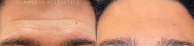 Woman treated with Plasma Pen - Woman treated with Plasma Pen