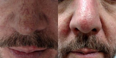 55-64 year old man treated with VeinGogh  for Facial Spider Veins - After 20 minute session with Ohmic Thermolysis (VeinGogh).VeinGogh treatment is instantaneous for facial spider veins and has no hyper-pigmentation or hypo-pigmentation risks as may occur with surface laser or IPL treatments.