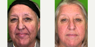 55-64 year old woman treated with Halo Laser, Skin Rejuvenation - Patient had a Halo/BBL combination treatment plus exclusive Elevai skin care regimen.