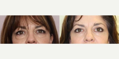 Woman treated with Eyelid Surgery - Woman treated with Eyelid Surgery