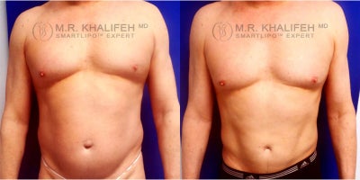 55-64 year old man treated with Liposuction - This fit 55 year old Bethesda liposuction patient was looking for enhancement in what had become stubborn male areas: abdomen and flank regions. He underwent smartlipo triplex tot he areas, and pictures are shown about 6 months postoperatively.