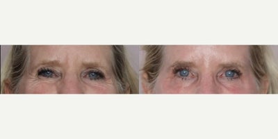 Woman treated with Botox - Woman treated with Botox