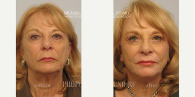 Woman treated with Profound RF - Woman treated with Profound RF