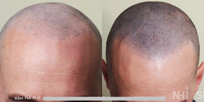 25-34 year old man treated with Scalp Micropigmentation - Scalp Micropigmentation