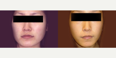 Woman treated with Jaw Reduction - Woman treated with Jaw Reduction