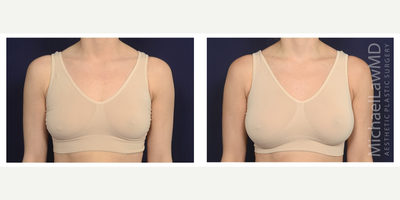 25-34 year old woman treated with Mentor Breast Implants - Breast augmentation. Follow-up photos taken 3 months after the procedure.