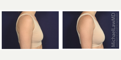 25-34 year old woman treated with Mentor Breast Implants - Breast augmentation. Follow-up photos taken 3 months after the procedure.