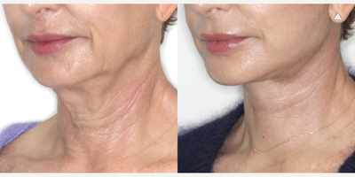 Woman treated with Deep Plane Facelift, Neck Lift - Deep Plane Face and Necklifts have become the procedure of choice for facial rejuvenation.This shows the Left Lateral Before / After fade at only 8 weeks post Deep Plane Face and Neck Lift.The patient had noticed signs of ageing including loose skin and soft tissue around her mouth, along her jawline (jowls) and her neck.Now at 8 weeks postop:Note the improved jawline and neck contour. There is no redundant neck tissue.Deep Plane Face and Neck lifts are natural-looking because the patient's own ligaments are re-tensioned and repositioned. Deep Plane Face and Neck lifts are ideal for younger or older patients.