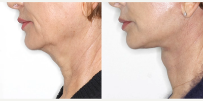 Woman treated with Deep Plane Facelift, Neck Lift - Deep Plane Face and Necklifts have become the procedure of choice for facial rejuvenation.This shows the Left Lateral Before / After fade at only 8 weeks post Deep Plane Face and Neck Lift.The patient had noticed signs of ageing including loose skin and soft tissue around her mouth, along her jawline (jowls) and her neck.Now at 8 weeks postop:Note the improved jawline and neck contour. There is no redundant neck tissue.Deep Plane Face and Neck lifts are natural-looking because the patient's own ligaments are re-tensioned and repositioned. Deep Plane Face and Neck lifts are ideal for younger or older patients.