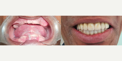 Man treated with All-on-4 Dental Implants, Dental Implants, Porcelain Veneers - Man treated with All-on-4 Dental Implants, Dental Implants, Porcelain Veneers