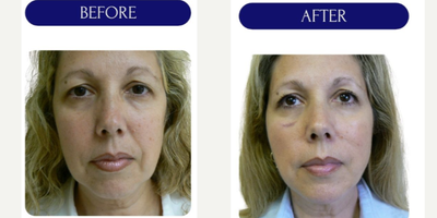 55-64 year old woman treated with Thread Lift, MINT threadlift - mint threadlift