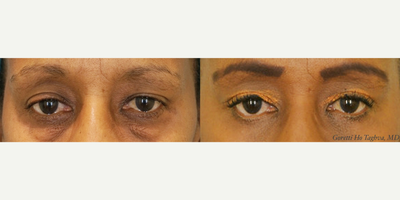 45-54 year old woman treated with lower eyelid surgery - 45-54 year old woman treated with lower eyelid surgery
