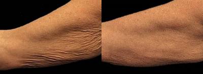 45-54 year old woman treated with Thermage - 3 months after Thermage arms