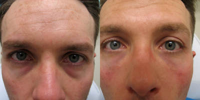 35-44 year old man treated with Restylane Refyne - Restylane Refyne for tear troughs. Done with a Softfil cannula for less pain and no downtime.