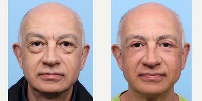 55-64 year old man treated with Eyelid Surgery, Double Eyelid Surgery - At 60, this patient turned to Dr. Wise for an upper and lower blepharoplasty to reduce heavy upper lids and under-eye bags that made him look constantly tired. Now, his eyes appear brighter and more alert, reflecting how vibrant he truly feels.