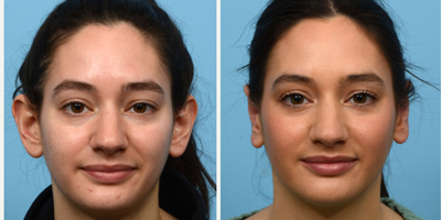 25-34 year old woman treated with Ear Surgery - 26-year-old otoplasty was not happy with the prominence of her ears. Dr. Wise performed an otoplasty and 2 months post-op the patient is very happy with her results!