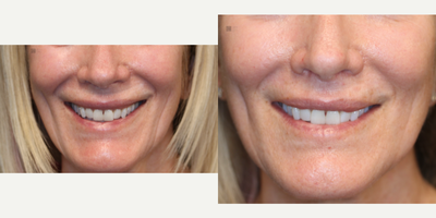 Revision eyelid surgery and lip lift - Lip filler corrected with lip lift and eyelid surgery revised on upper and lower lids, prior laser scaring corrected.