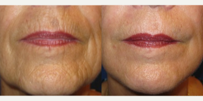 Lip Lines treated with Fat Transfer and Fractional CO2 Laser Skin Resurfacing - This patient came to visit with me not knowing what could be done for the lines around her mouth. She had heard about laser, but was concerned that it would not help. After taking the time to understand her goals and the components of her aging pattern, I created a treatment plan that consisted of fat transfer to restore volume to her upper and lower non-red lip, combined with fractionated CO2 laser resurfacing to restore collagen in the skin of her non-red lip area. This combination of procedures is my 1-2 punch to undo this complex aging pattern, while still maintaining a natural lip appearance. Most of her recovery took about 7 days. Her after pictures were taken at 3 months.