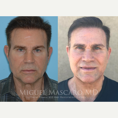 55-64 year old man treated with Facelift - 2 months post lip lift and extended seep plane facelift.