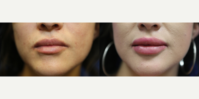 25-34 year old woman treated with Lip Implants - This patient in her mid-twenties desired plumper lips. She didn't want to return to the office every 8 months for lip fillers, so she opted for the Permalip permanent lip implant. The procedure took around 30 minutes and she now has the perfect pout.