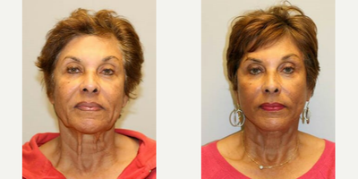 Woman treated with Cheek Augmentation - Woman treated with Cheek Augmentation through fat transfer from abdomen. She also had Deep Plane Facelift with platysmaplasty as well asNeck Lift.