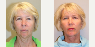 50 year old woman treated with Cheek Augmentation - 50 year old woman treated with Cheek Augmentation through fat transfer. She also had Facelift, Neck Lift, Chin Implant, Temple Brow Lift and Laser Resurfacing. Pre-op, she was concerned with looking tired and looking older than she feels. She has had no previous cosmetic plastic surgery and no previous treatments.